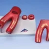 Modello di arteriosclerosi, con sezione delle arterie (in 2 parti