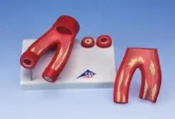 Modello di arteriosclerosi, con sezione delle arterie (in 2 parti