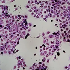 Morfologia delle cellule cancerose