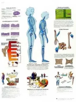 Osteoporosi - Tavola didattica laminata 50x67 cm