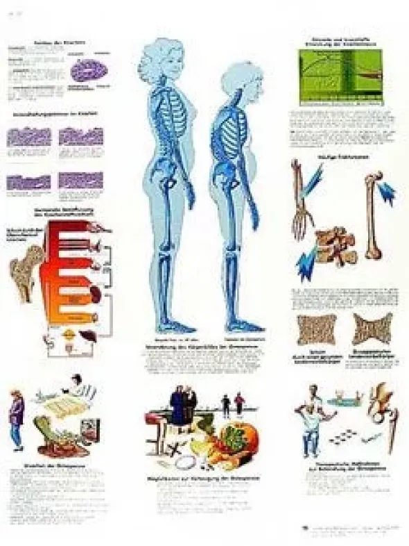 Osteoporosi - Tavola didattica laminata 50x67 cm