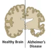 Ricerca Alzheimer mediante ELISA