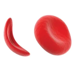 Sickle Cell Gene Detection (DNA-based)